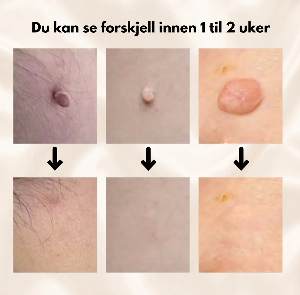 HudtagFritt™
