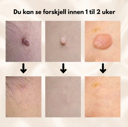 HudtagFritt™